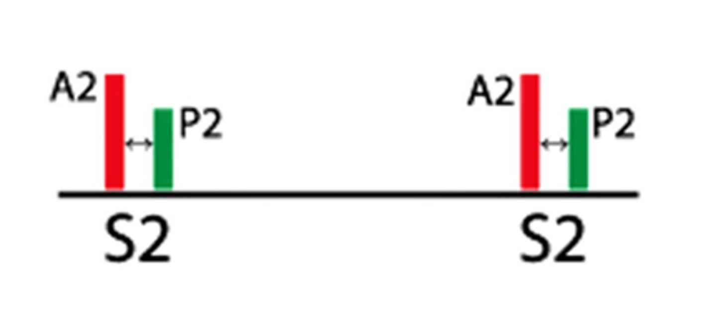 <p>splitting sound during expiration</p><p>splitting sound during inspiration</p>