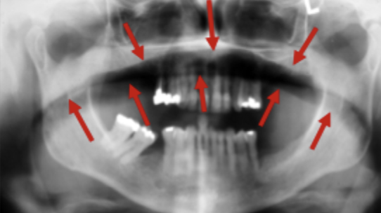 <p>Patient position - Air shadow</p>