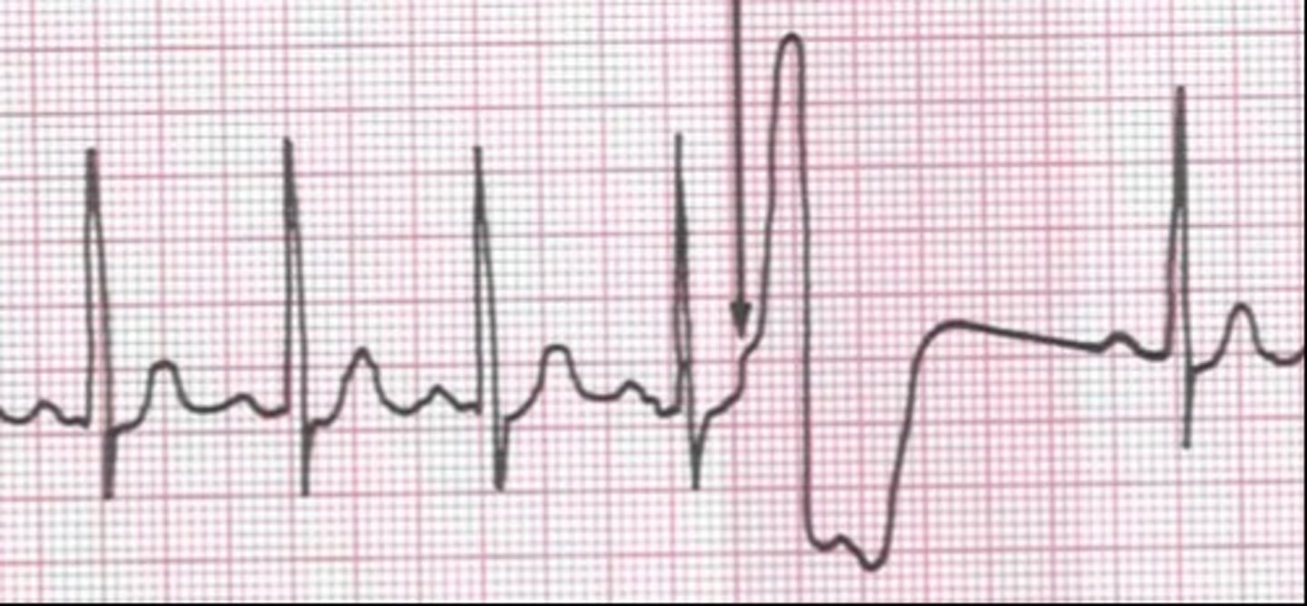 <p>PVC occurring on or near T wave</p>