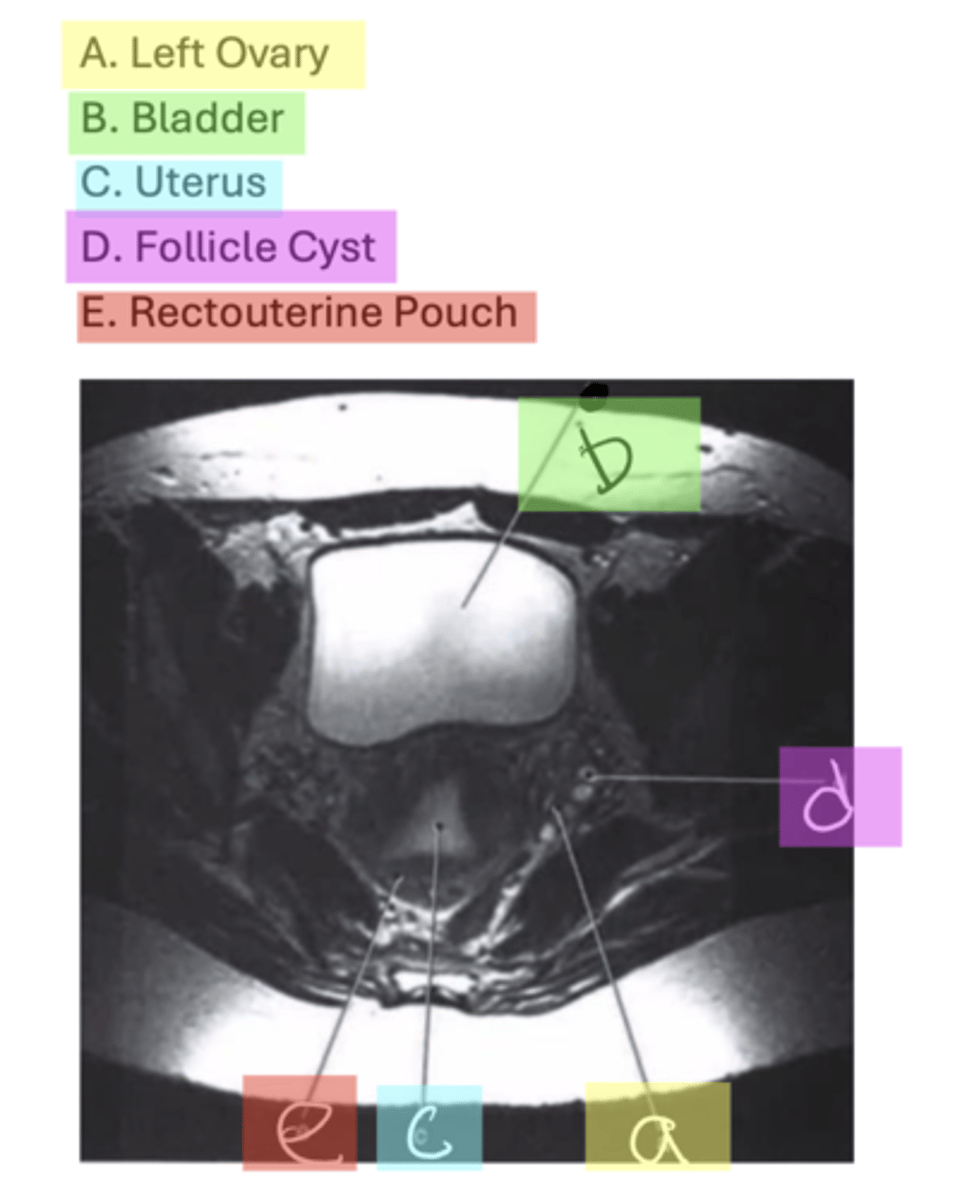 <p>A. Left Ovary</p><p>B. Bladder</p><p>C. Uterus</p><p>D. Follicle Cyst</p><p>E. Rectouterine Pouch</p>