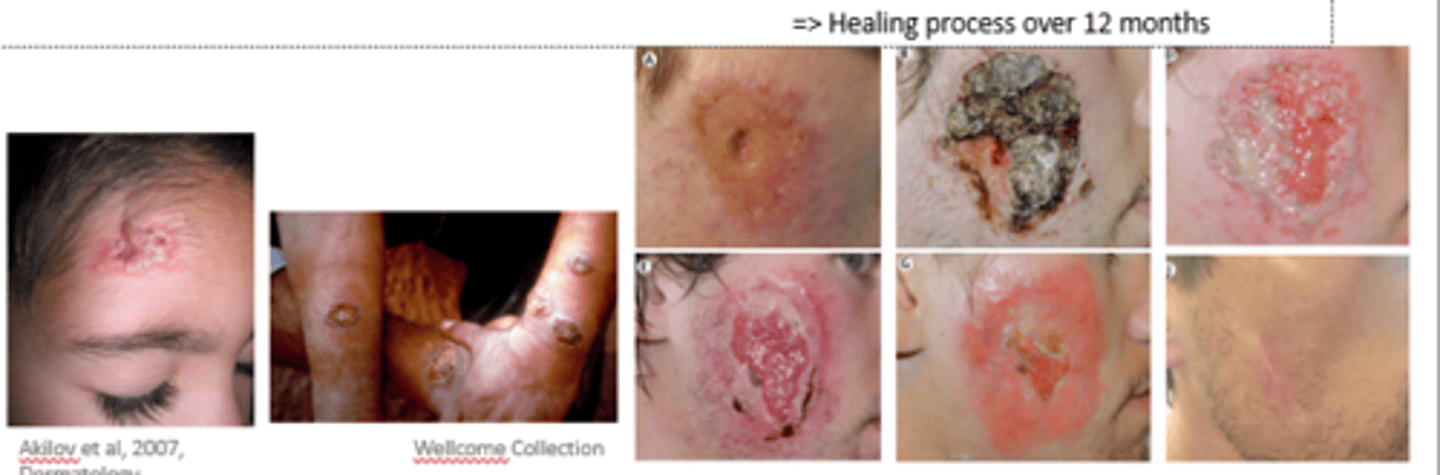 <p>•&nbsp; Involves skin epithelial cells at site of sand fly bite => skin lesions on exposed body parts</p><p>•&nbsp; caused by L. tropica, L. major complexes (Old World) and L. mexicana, L. braziliensis complexes</p><p>&nbsp; (New World)</p><p>•&nbsp;&nbsp;&nbsp; self healing after months to years often with scaring.</p><p>•&nbsp;&nbsp;&nbsp; Often multiple lesions in close proximity</p>