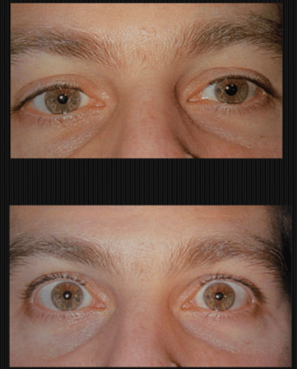 <p>tonic pupil will constrict more in response to dilute pilocarpine (bc the eye was starved)</p>