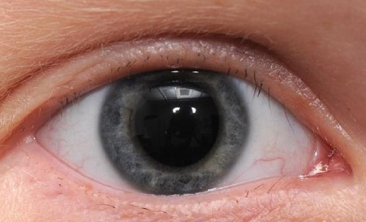 <p>What eyelash condition is this?</p>