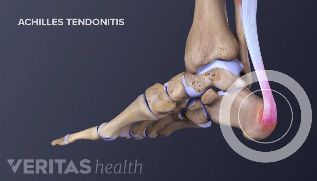 <p>What is a tendon + fx ?</p>