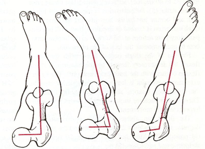 <p>Which leg indicates an excessive anterversion?</p>