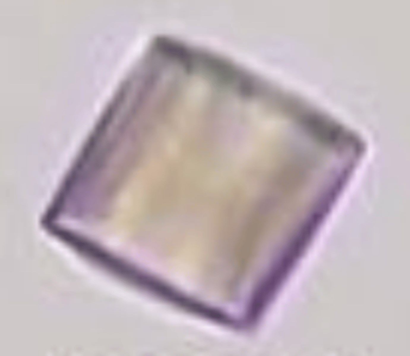 <p>NORMAL (mostly)</p><p>- acidic</p><p>- pleomorphic</p><p>- yellow/brown or colourless</p><p>- seen in NORMAL and in diseases</p><p>- GOUT MARKER</p><p>- could be from kidney stones</p><p>- Lesch-Nyhan</p><p>- chemo</p><p>- leukemia</p>