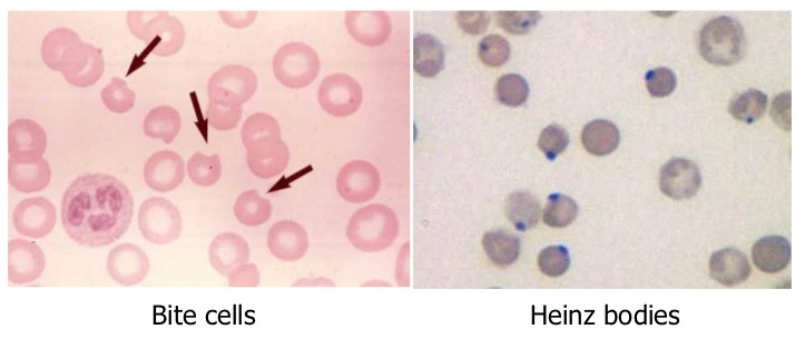 <p>Denatured hemoglobin that has precipitated out of the cell and attached to the surface</p>