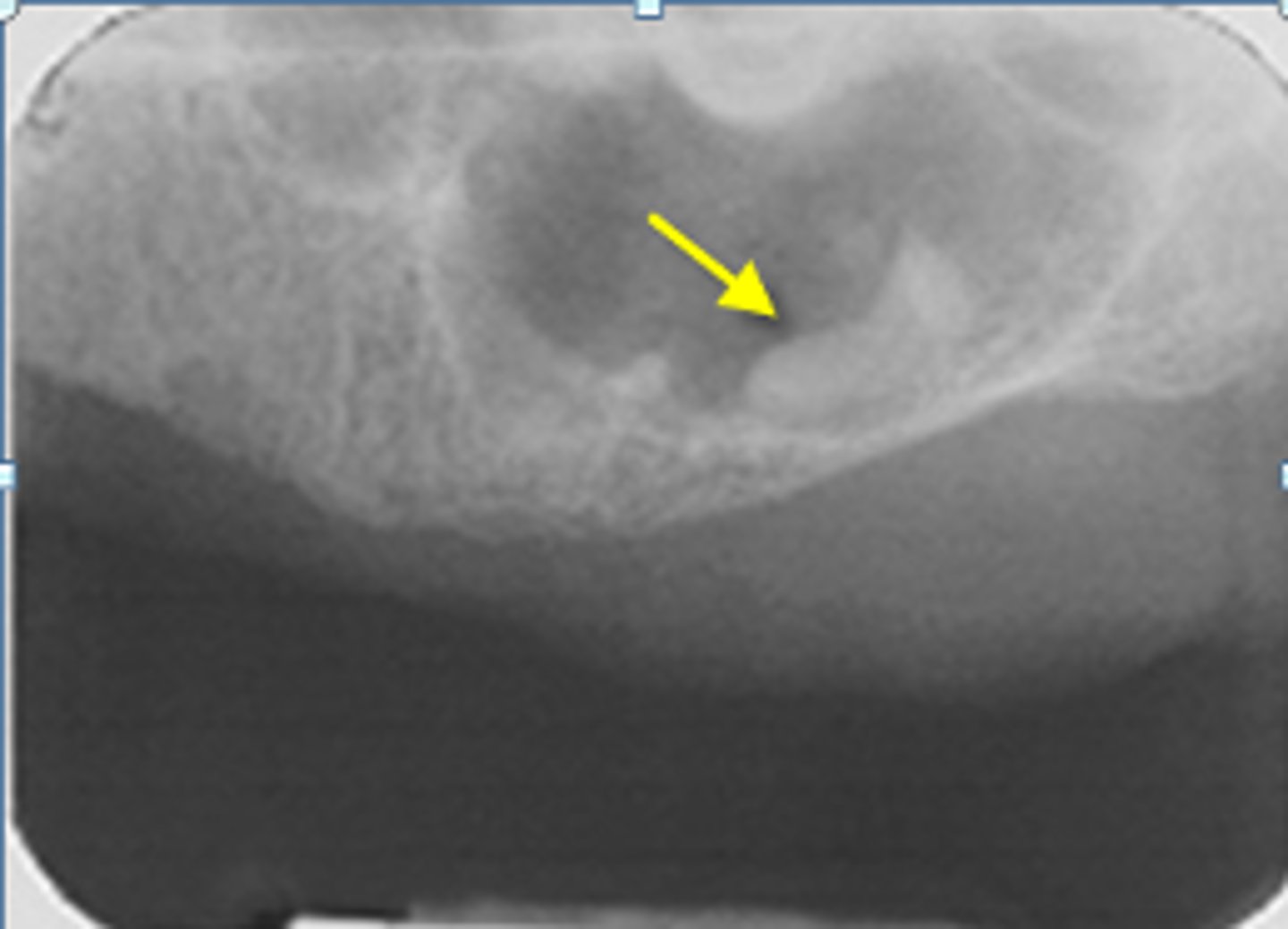 <p>ID the calcified abnormality:</p>