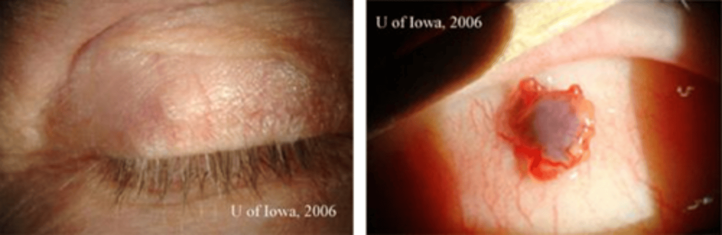 <p>aggressive local extension, including into conj = pagetoid spread = upward/different directions of spread of cancer cells to epithelium = forms isolated skip lesions/islands</p>