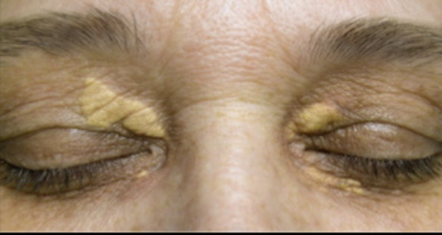 <p>Xanthlasma</p>