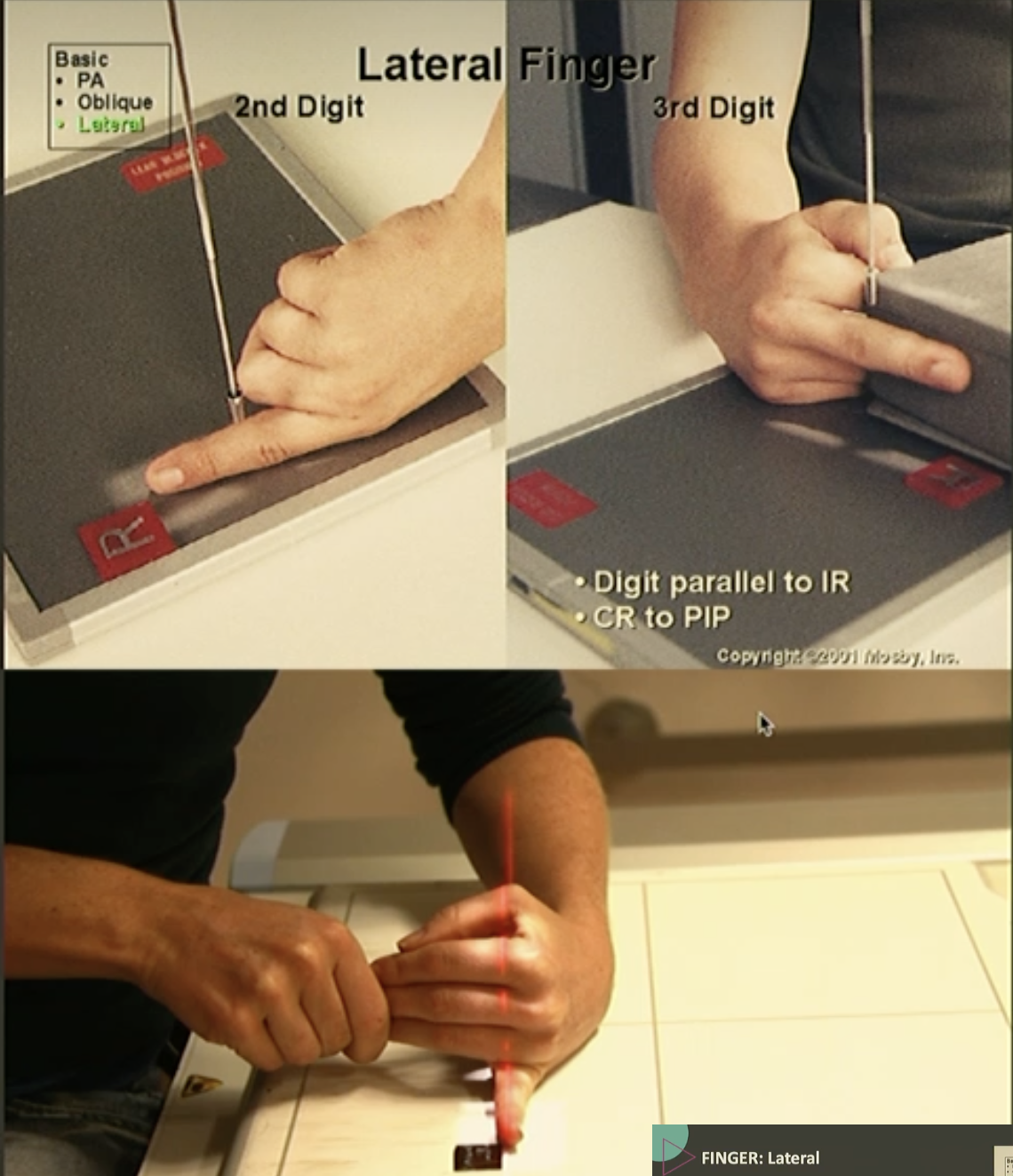 <p>Fine FS, 100cm</p><p>55kVp/1mAs</p><p>Straight tube</p><p>CR: Distal portion of proximal phalanx</p>