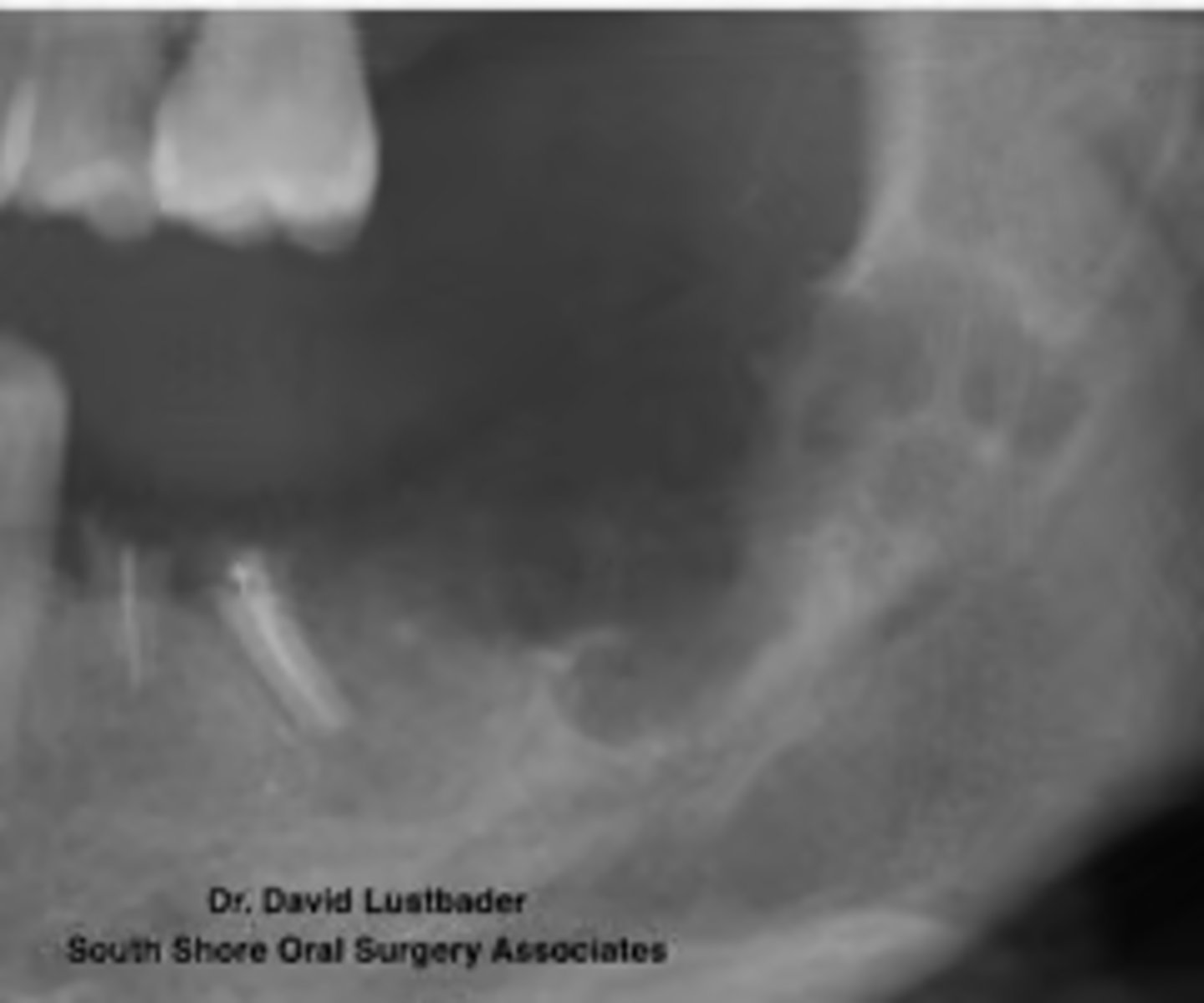 <p>ID pathology based on radiographic features:</p><p>- Usually multilocular</p><p>- “Soap bubble” or “honeycomb”appearance</p><p>- Buccal and/or lingual cortical expansion</p>