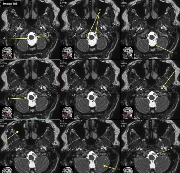 <p>Letter B in Image 188 is poinitng to which cranial nerve?</p>