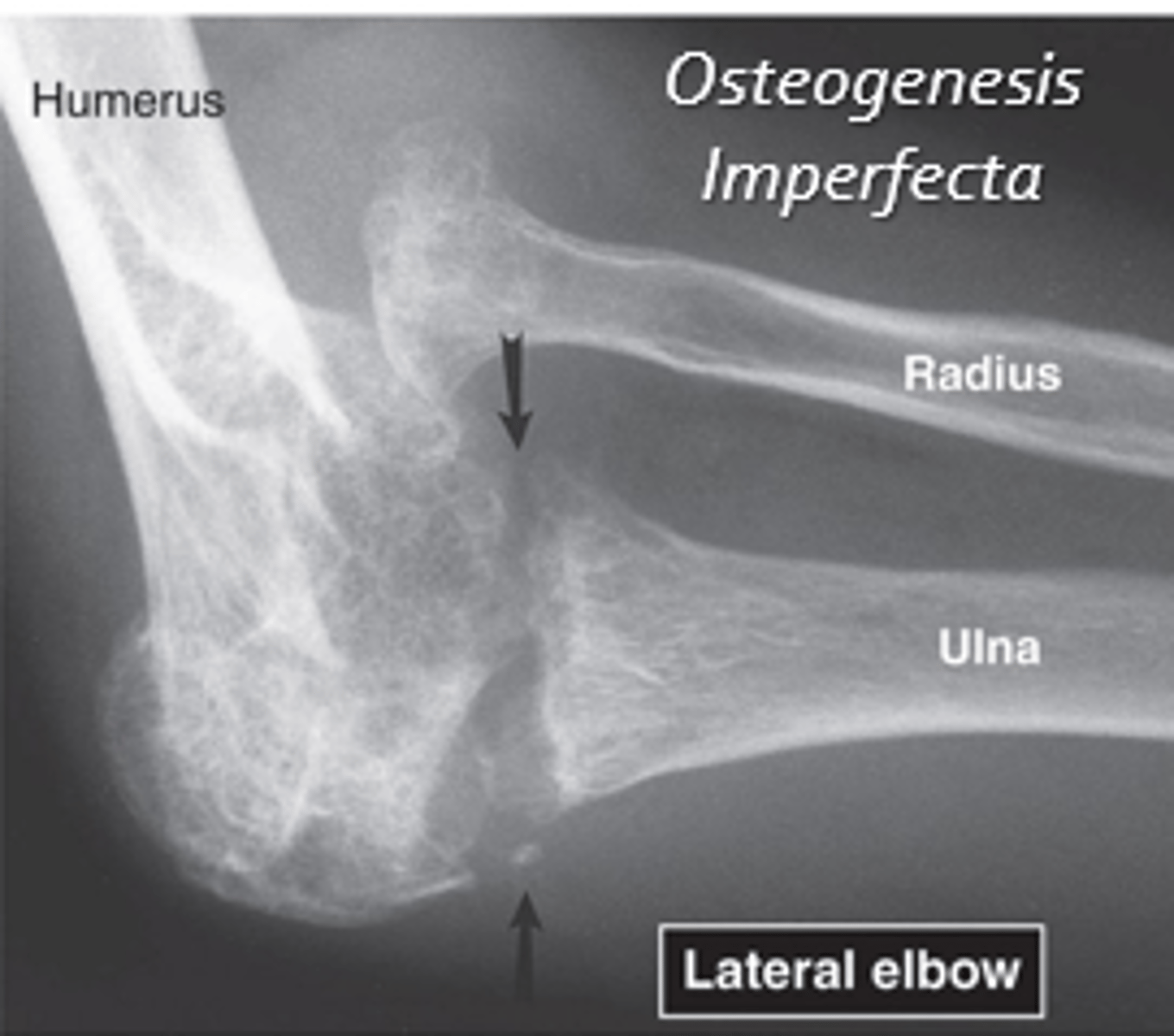 <p>- Bones structurally weakened by pathological process</p><p>- Osteogenesis imperfecta: a disease characterized by abnormal maturation of collagen, affecting both intramembranous and endochondral bone formation. (Congenital)</p><p>- Osteoporosis: a disease characterized by low bone mass and structural deterioration of bone tissue, leading to bone fragility and an increased risk of fractures of the hip, spine, and wrist. (Acquired)</p><p>- Other reasons: Tumors, infections, disuse, sequelae of irradiation, prosthetic joint replacements, bone graft fractures.</p>