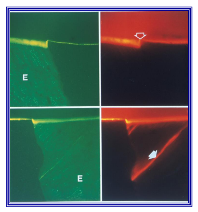 <p>Re-etch margins after polishing, then apply resin helps to seal any minor cracks that come from cavity preparation or any cracks in the margins of the restoration&nbsp;</p>