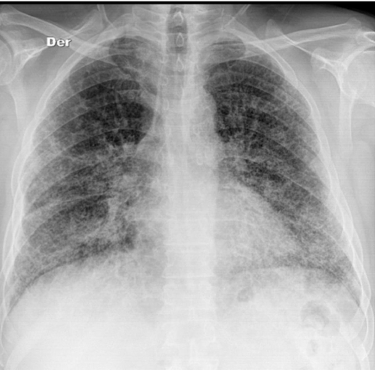 <p>What is this pattern of lung disease?</p>