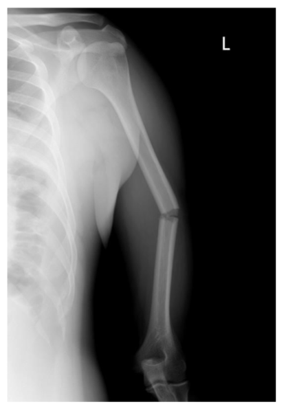 <p>What type of fracture?</p>