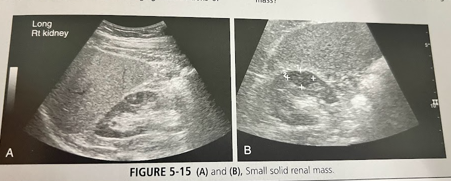 <p>A 60 year old man is seen by his doctor for a routine exam. A routine lab work-up is performed, and microscopic hematuria is found. The pt has mild hypertension and hx of cigarette smoking. A UT sonogram is requested to help find the cause of the hematuria. These findings are seen in this image. What is the most likely diagnosis and how does pt hx contribute?</p>