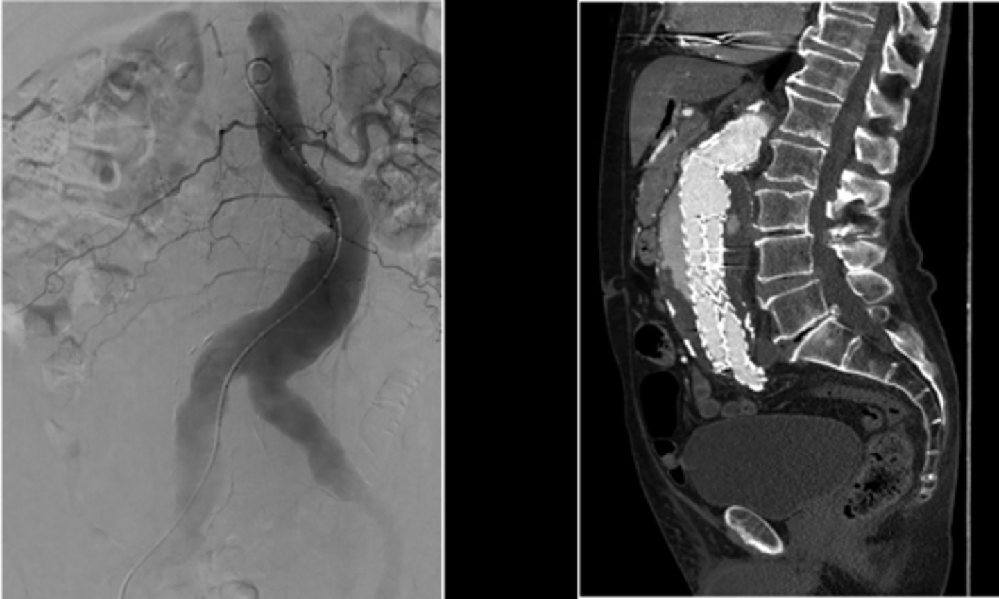 <p>Digital subtraction angiography (DSA)</p><p>Computed tomographic angiography (CTA)</p>