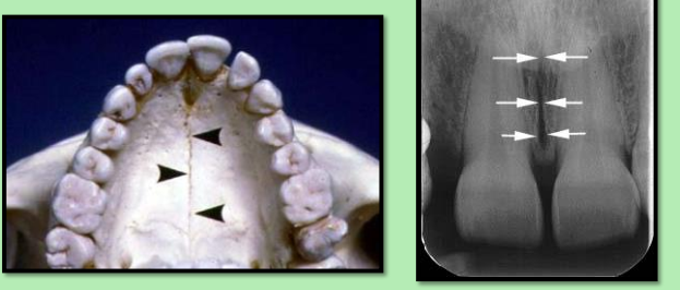 <ul><li><p>Only found in the skull ! </p></li><li><p>Radiolucent </p></li><li><p>Ex. Medial palatal suture </p></li></ul><p></p>
