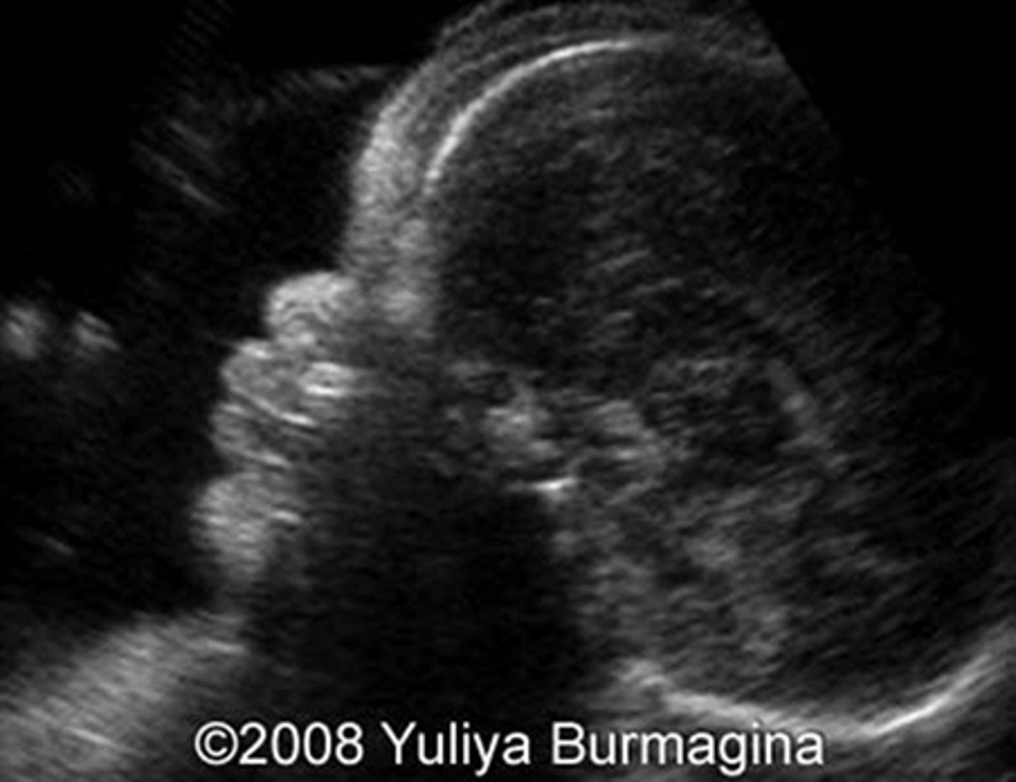 <p>Protruding forehead</p>