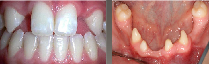 <p>A condition where a few teeth are missing, usually 6 or less.</p>