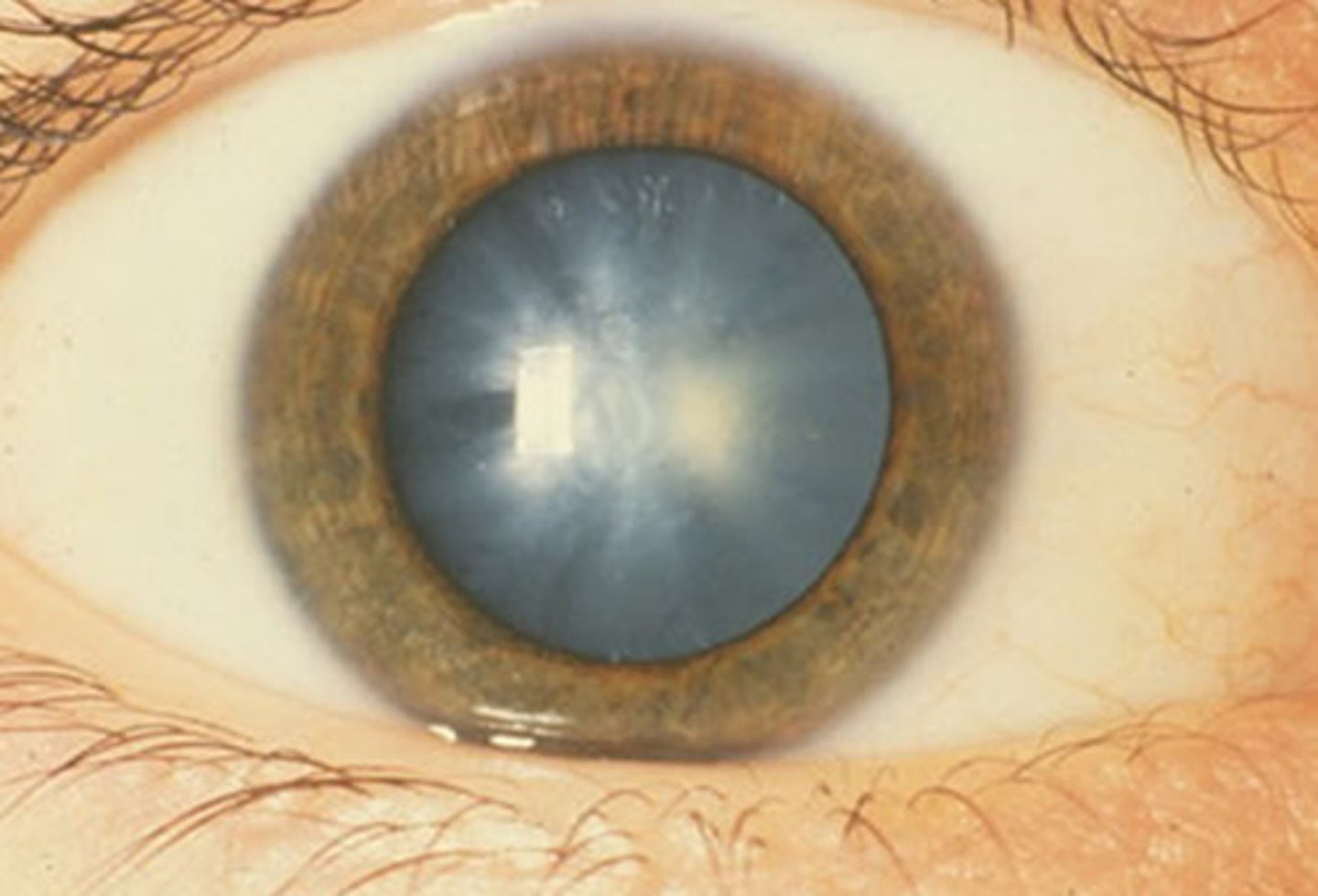 <p>clouding of the lens</p><p>natural age related process</p>