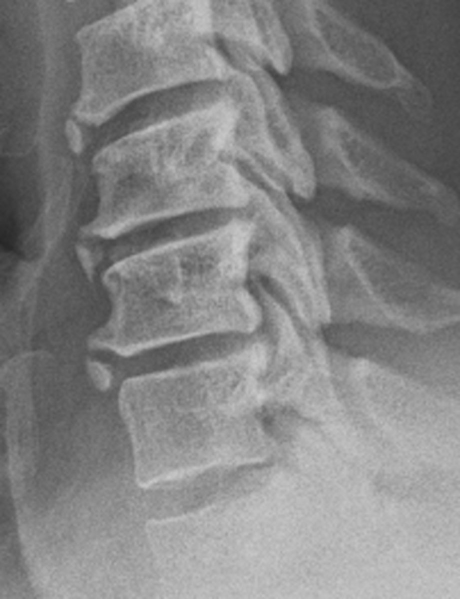 <p>Calcification within the annular fibers</p><p>- A sign of degenerative disc disease</p>