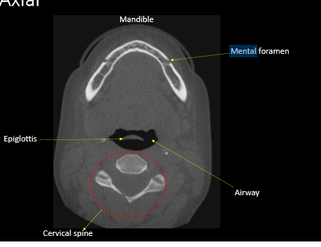 <p>mental foramen</p>