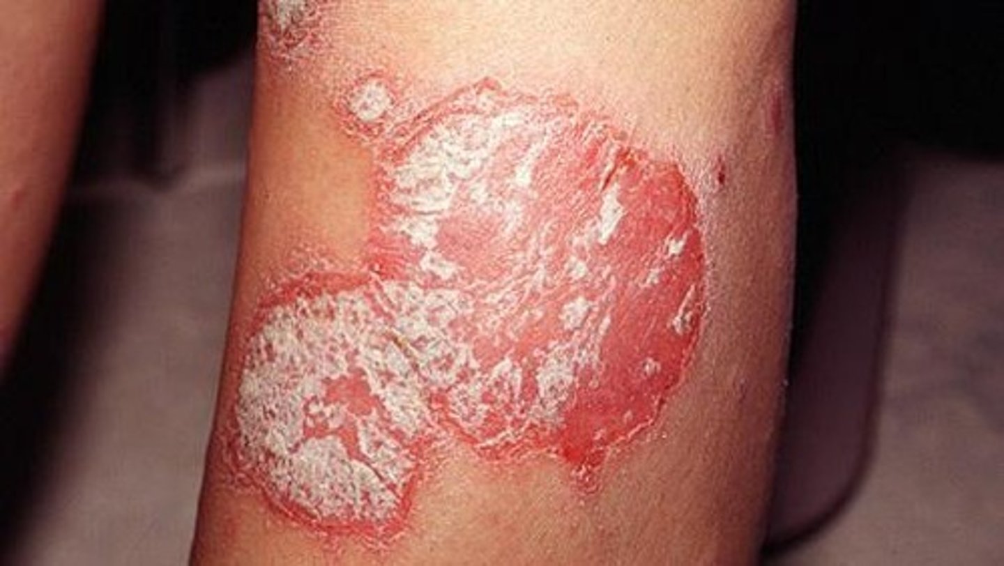 <p>epidermal thickening from elongated rete ridges</p><p>ex. psoriasis</p>