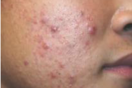 <p>Nodulocystic</p>
