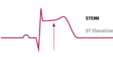 <p><u>In STEMI</u></p><ul><li><p>Normal _ wave, narrow __, except __ segment is elevated</p></li><li><p>May present with reciprocal __ to ST segment in other leads (complete 12 lead)</p></li></ul><p></p>