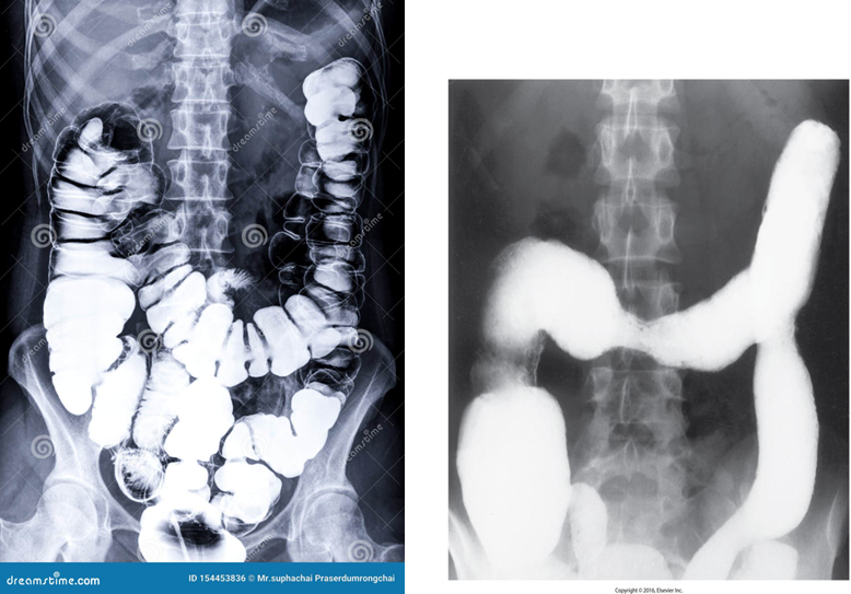 Left Image is normal