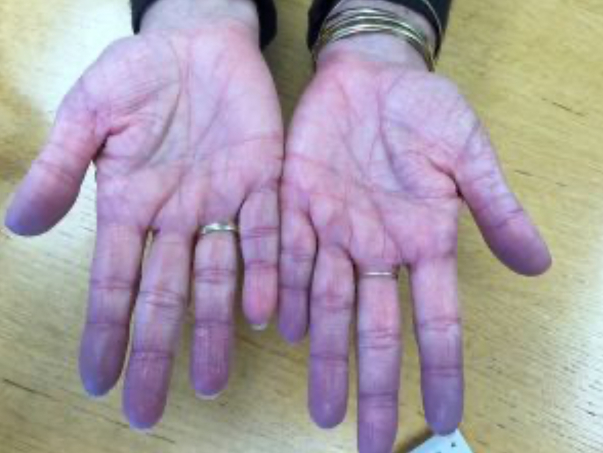<p>Cyanosis</p>