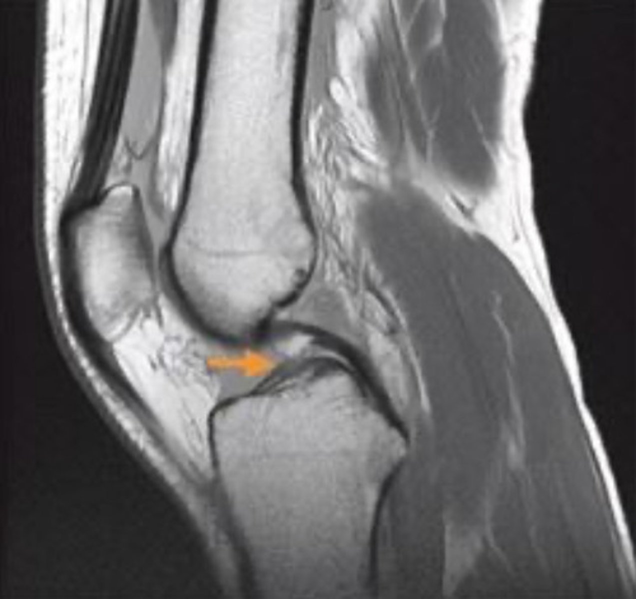 <p>anterior cruciate ligament</p><p>3 multiple choice options</p>