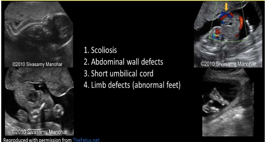<p>you identify a <strong>facial cleft, scoliosis, gastroschisis</strong>, and a very short or absent umbilical cord on a 25w fetus</p><p>.</p><p>a) tetralogy of fallot</p><p>b) trisomy 21</p><p>c) shone complex</p><p>d) limb-wall-body complex</p>