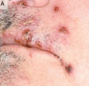 <p>What is the management for Varicella-Zoster Shingles (VZV/HHV3)?</p>