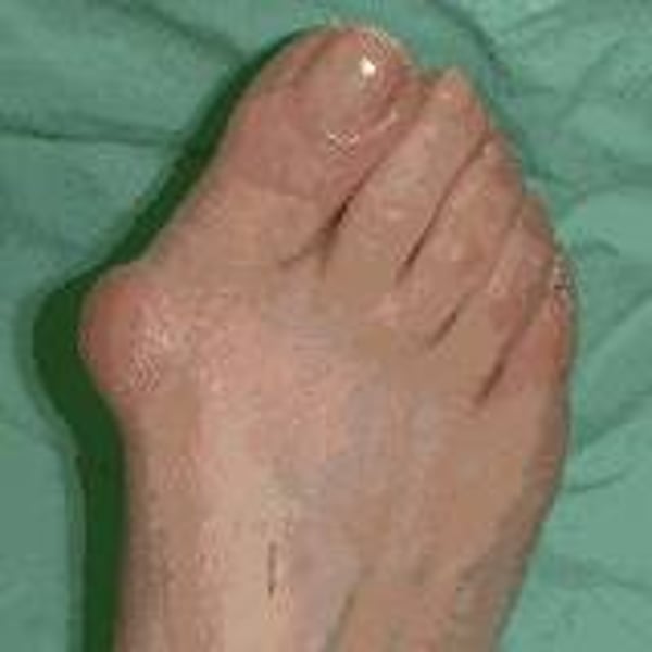 <p>Enlargement of <strong>bone</strong> or tissue around the joint at the base of the big toe</p>