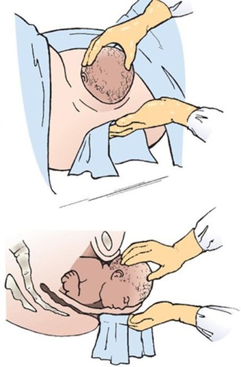 <p>A technique used to assist in the delivery of the baby's head to prevent it from getting stuck.</p>