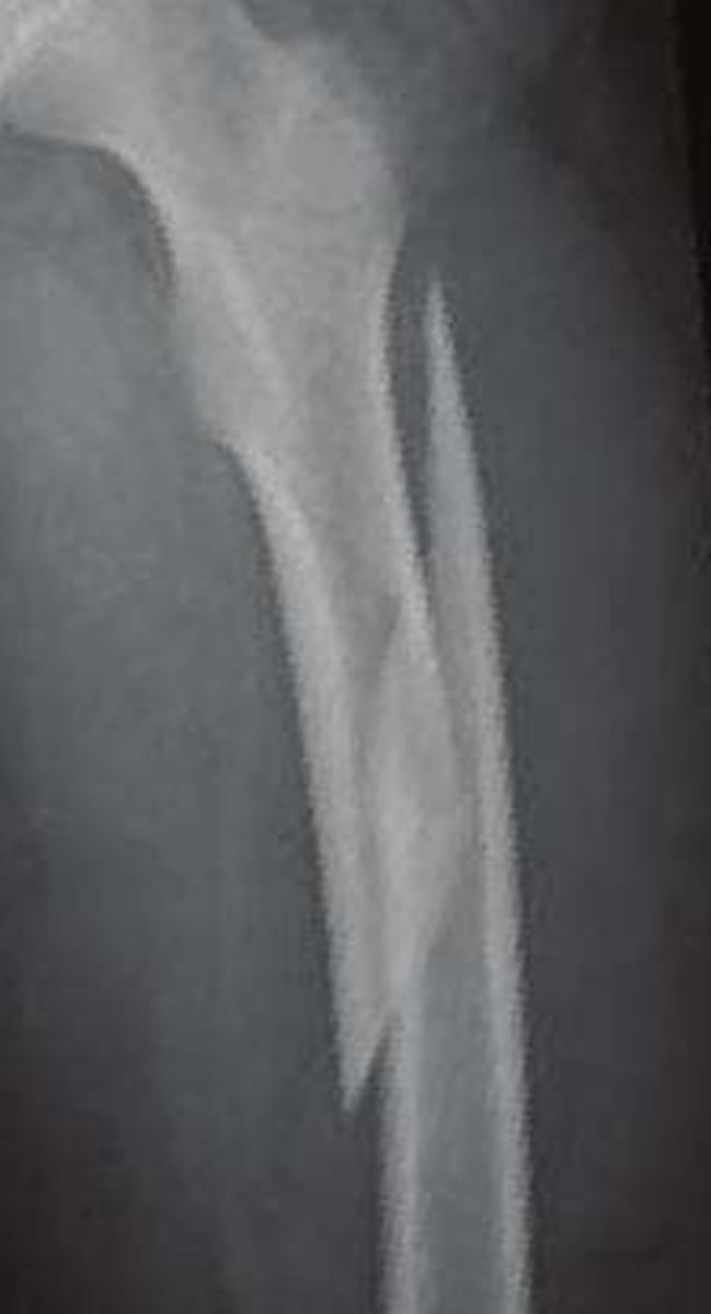 <p>What type of fracture is this?</p>