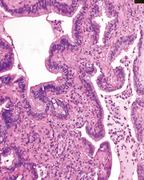<ul><li><p>Patchy, progressive bilateral interstitial fibrosis and respiratory failure, CRPD</p></li><li><p>Unknown etiology, said to have genetic component, seen after 50 yo</p></li><li><p>Germline MUC5B gene has telomerase loss and results in reduced mucin production and excessive fibroblastic proliferation → can be associated with smoking</p></li><li><p>Fibrotic lungs, <strong>patchy interstitial fibrosis</strong>, histology shows <strong>honeycomb</strong> shape, <strong>dry crackles</strong> during inspiration, dry cough, dyspnea on exertion, can lead to hypoxemia, cyanosis and clubbing</p></li></ul><p></p>