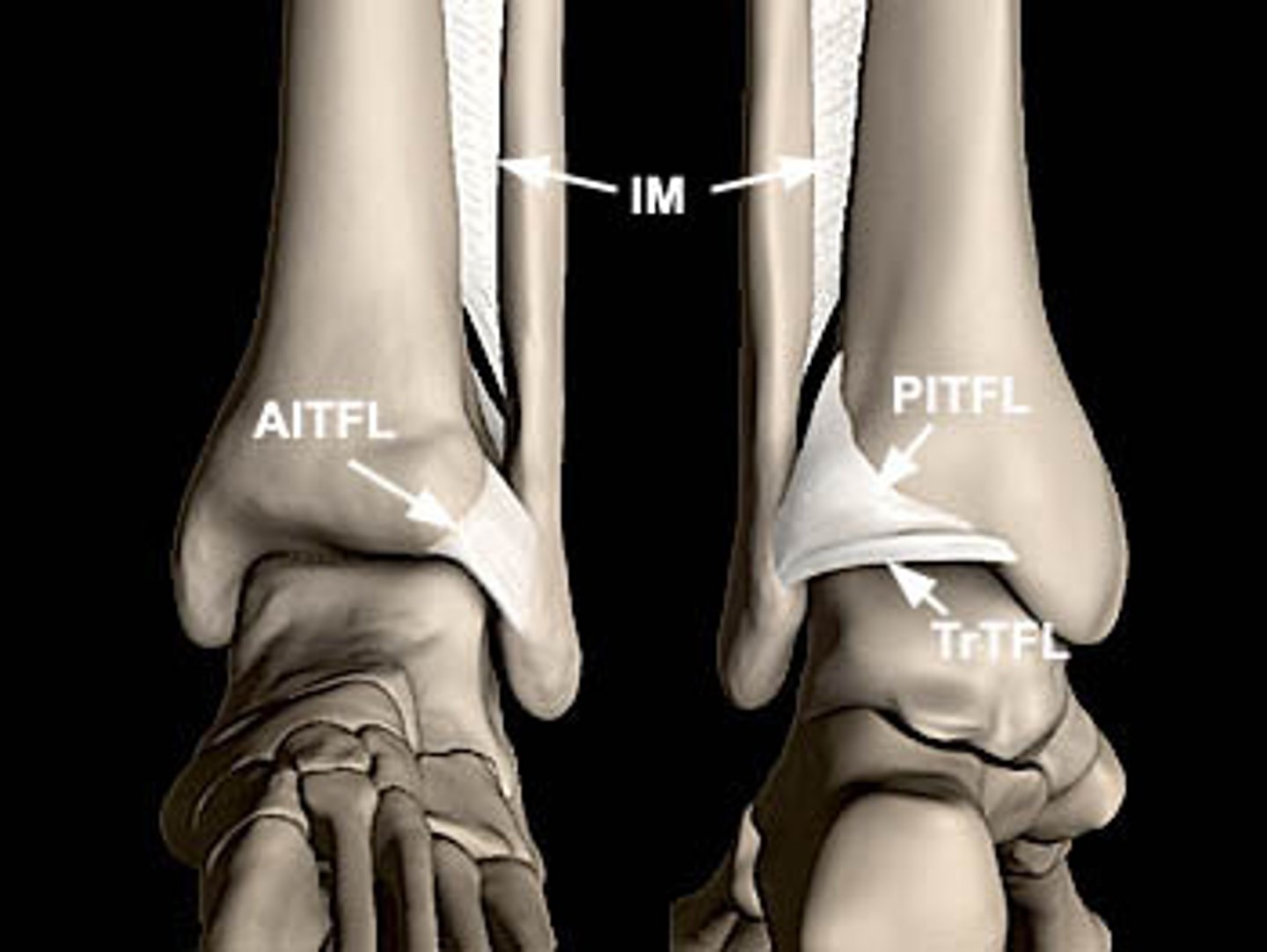 <p>Bind the tibia to the fibula.</p>
