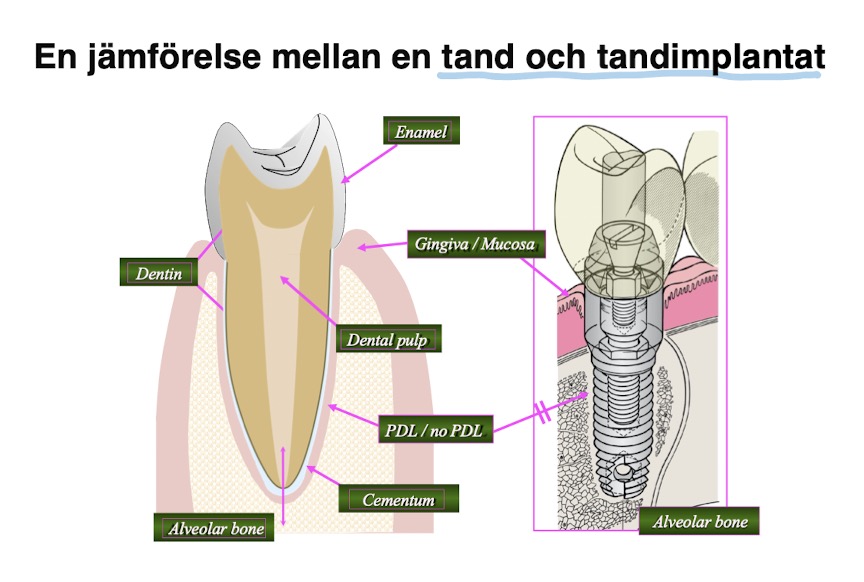 <p><strong><mark data-color="green" style="background-color: green; color: inherit">osseointegration</mark></strong><mark data-color="green" style="background-color: green; color: inherit"> =</mark></p><ul><li><p><mark data-color="green" style="background-color: green; color: inherit">den direkta förbindelsen som uppstår mellan benet och implantatets yta</mark></p></li><li><p><span style="color: #a7a3a3"><strong>tandimplantat</strong> gjort av <strong>titan</strong> har <u>unik förmåga att läka in i benet</u></span></p></li><li><p><span style="color: #a7a3a3">EJ paradontalligament</span></p></li><li><p><span style="color: rgb(142, 135, 135)">Eftersom vi inte har PDL är det extra viktigt att ha en korrekt höjd av kronan eftersom vi inte märker (nerver) om vi gör en för hård avritning -&gt; går sönder</span></p></li></ul><p></p>