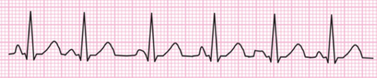 <p>Which Arrythmia is this?</p>