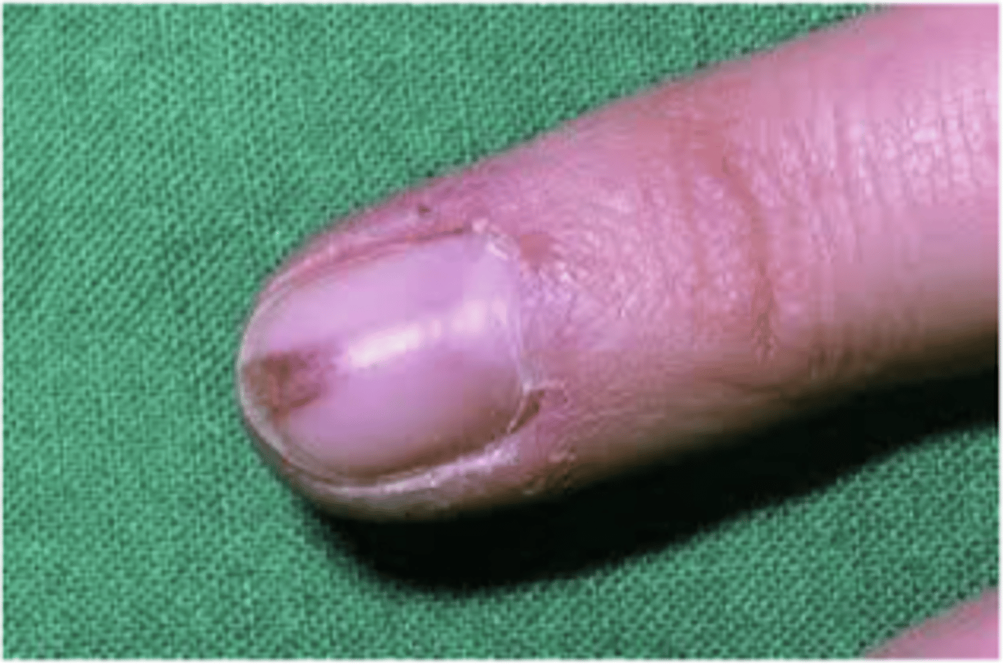<p>super painful</p><p>arises from modified smooth muscle cells of glomus body</p>