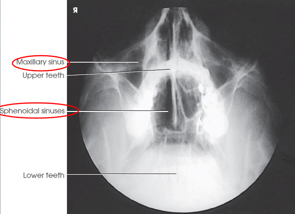 <ul><li><p>demonstrates:</p><ul><li><p>sphenoid sinuses through open mouth</p></li><li><p>maxillary sinuses</p></li><li><p>petrous pyramids lying inferior to maxillary floor</p><ul><li><p>(OML in proper position)</p></li></ul></li></ul></li><li><p>no rotation or tilt</p><ul><li><p>equidistant lateral borders of skull to lateral border of the orbits</p></li><li><p>summetric orbits and maxillary sinuses</p></li><li><p>MSP of head aligned with long axis of collimated field</p></li></ul></li><li><p>air-fluid levels, if present</p></li></ul><p></p>
