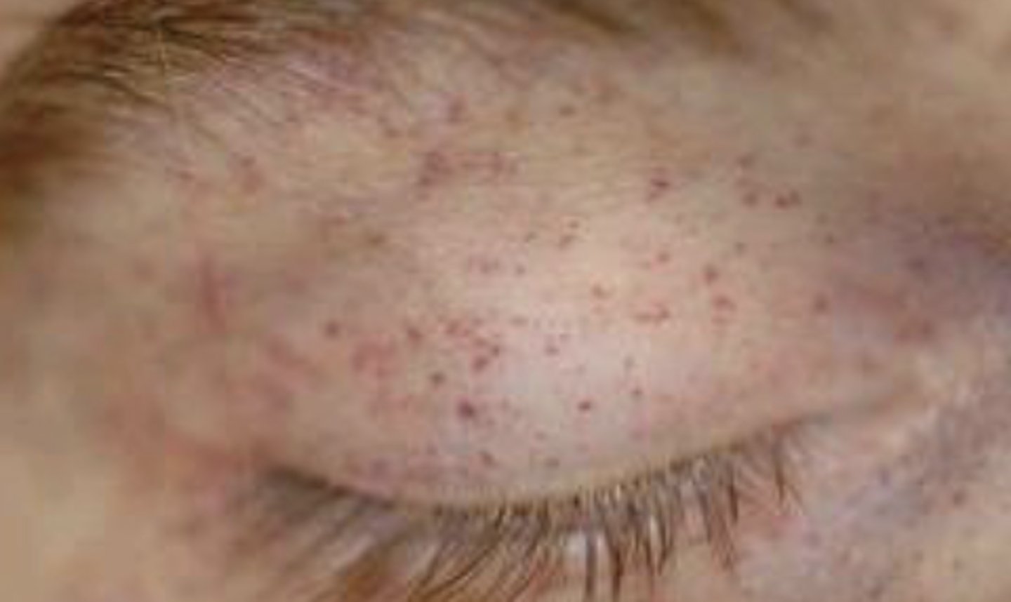 <p>Pin point (1-2 mm) red or purple papule or macule caused by hemorrhage</p>