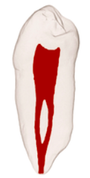 <p>(1-2-1)</p><p>one canal leaves the pulp chamber and divides into two in the root; the two then merge to exit as one canal</p>