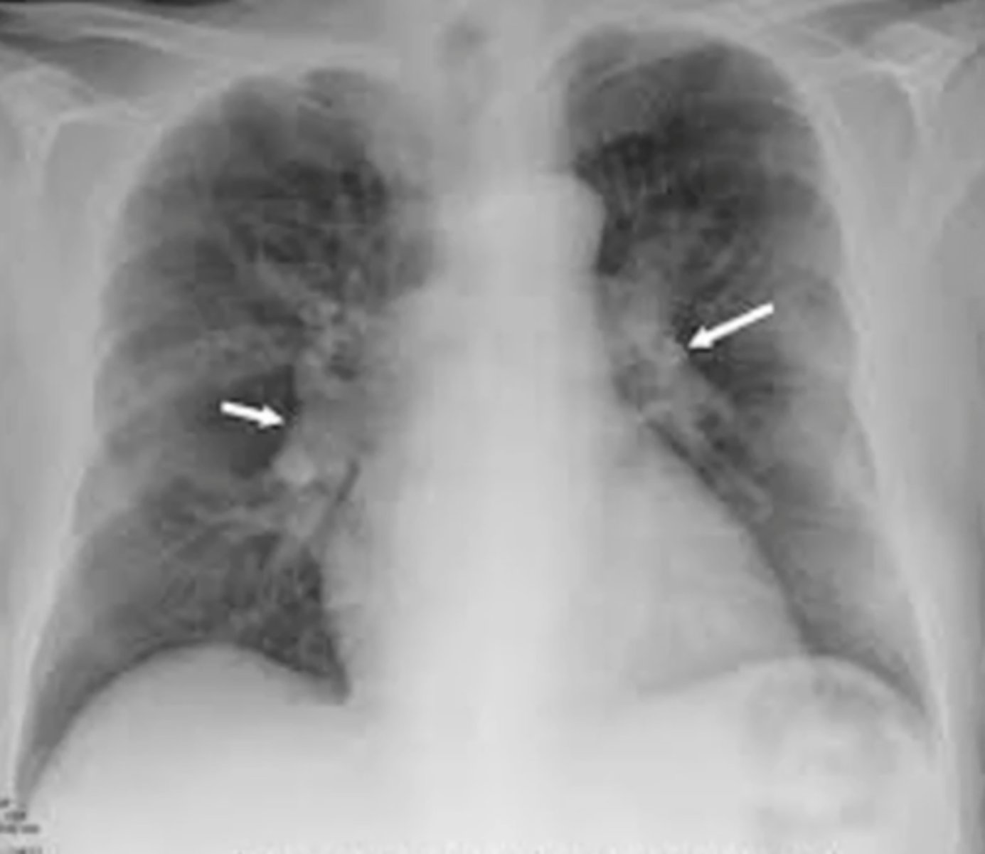<p>(evaluating AP CXR) 2 enlarged pulmonary vessels</p>