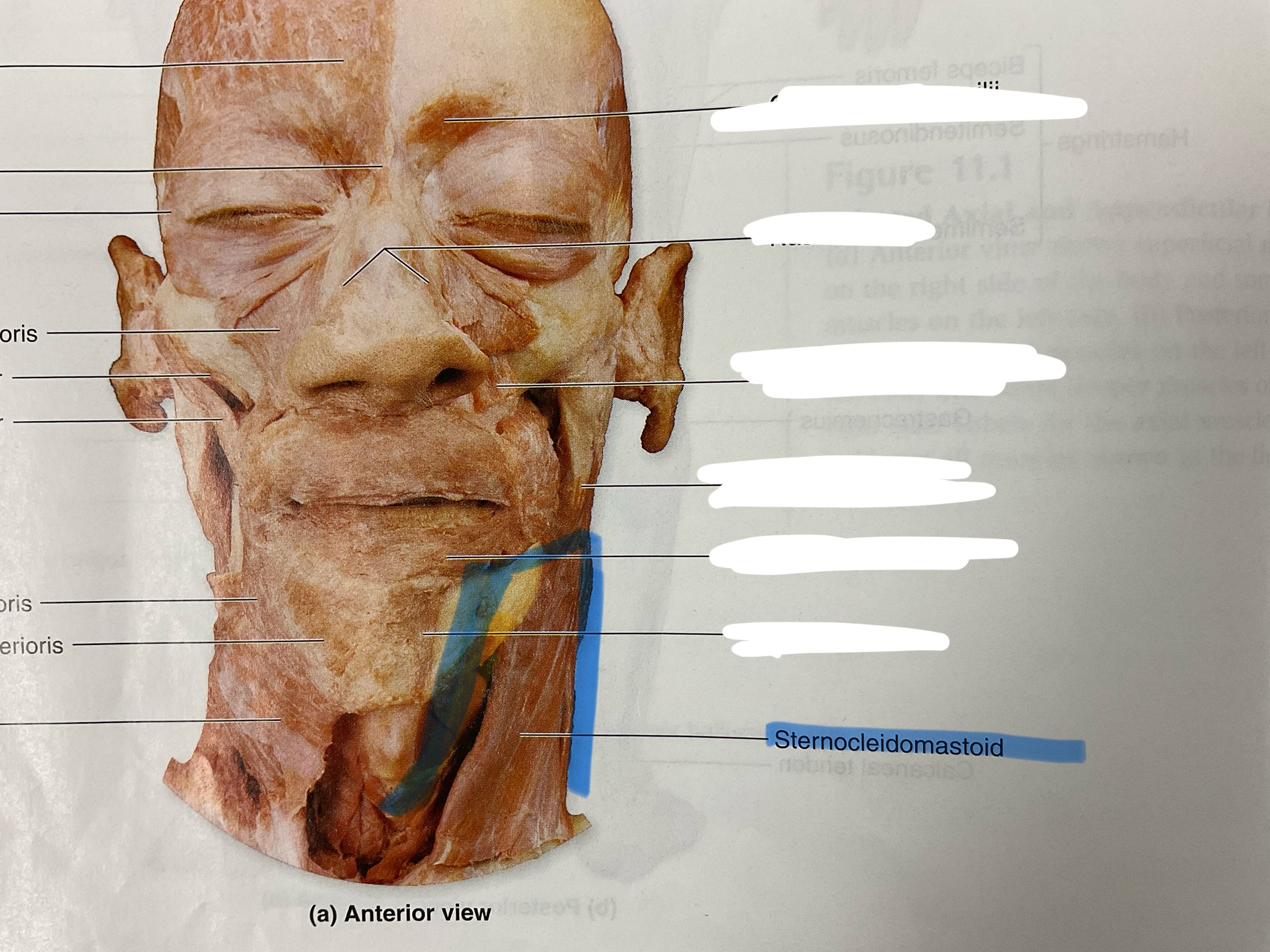 <p>Origin: manibrium and sternal end of clavicle </p>